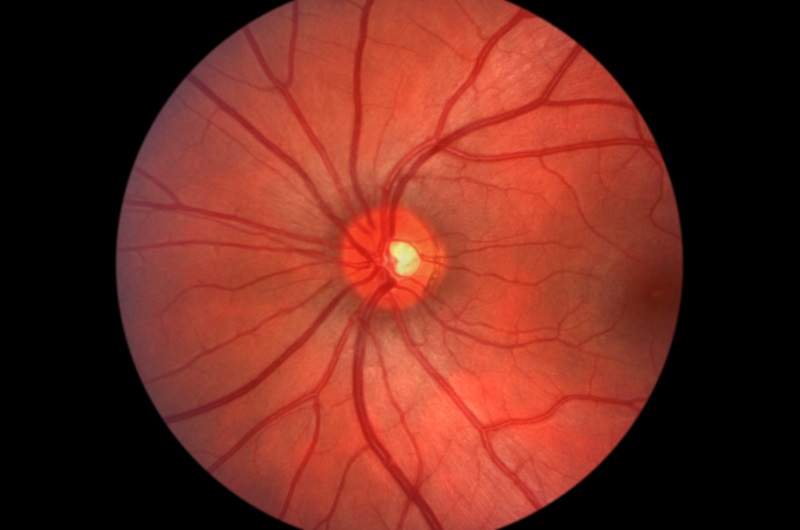 Glaucoma  Stamford, CT 
